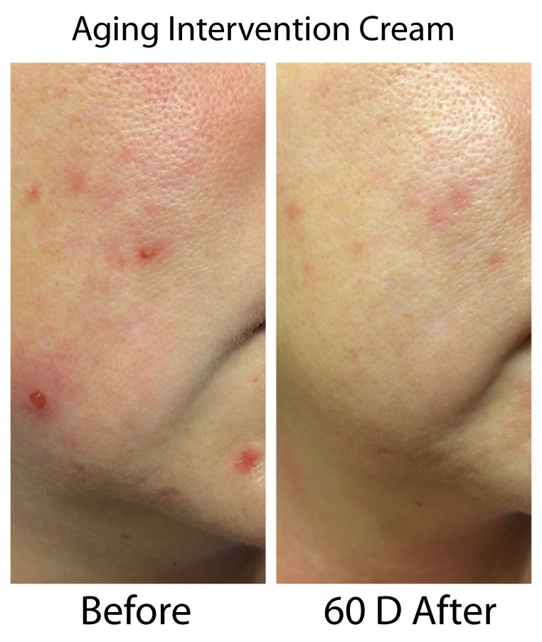 Skin 2 Skin Aging Intervention Before & After
